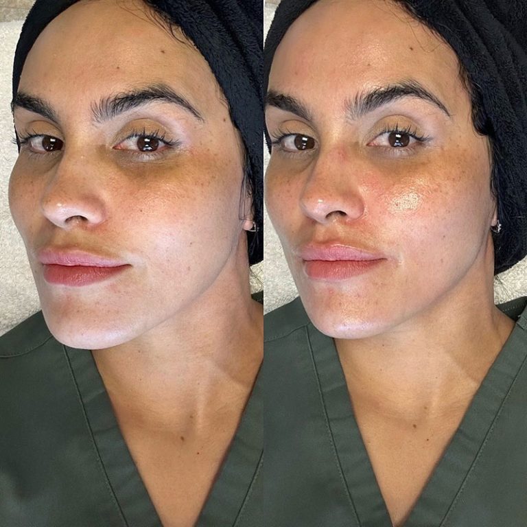 HydraFacial aftercare